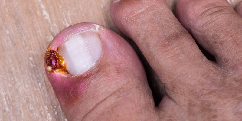 Ingrown Toenails and Nail Surgery